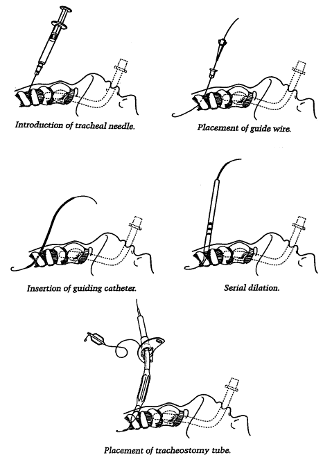 percutaneous tracheostomy procedure